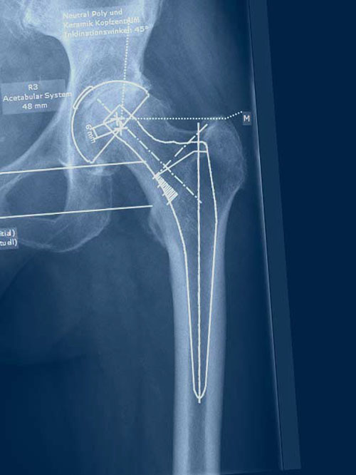 Philipp Nufer Orthopäde Hüftoperation