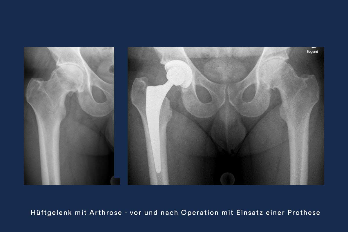 Philipp Nufer Hueftchirurg Hueftroentgenbild