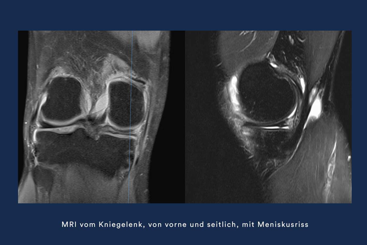 Philipp Nufer Kniespezialist MRI Meniskusriss